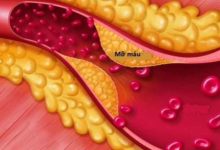 Uống thuốc hạ mỡ máu tốt nhất khi nào?